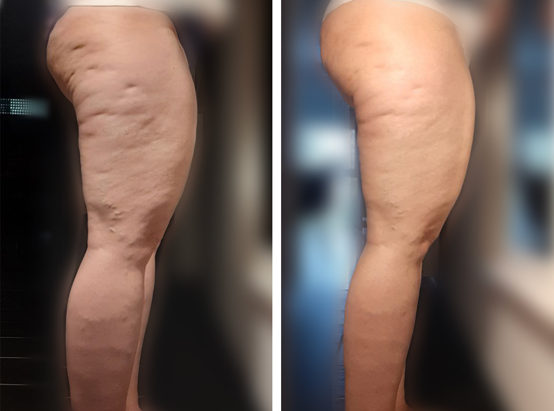 Knie straffen, Cellulite reduzieren, Bindegewebe und Beine straffen